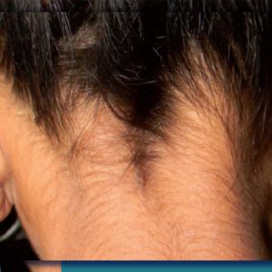 ماستوئیدیت چیست؟